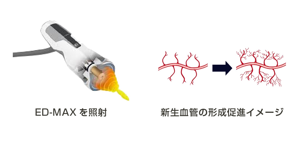ED-MAXによる治療のメカニズム